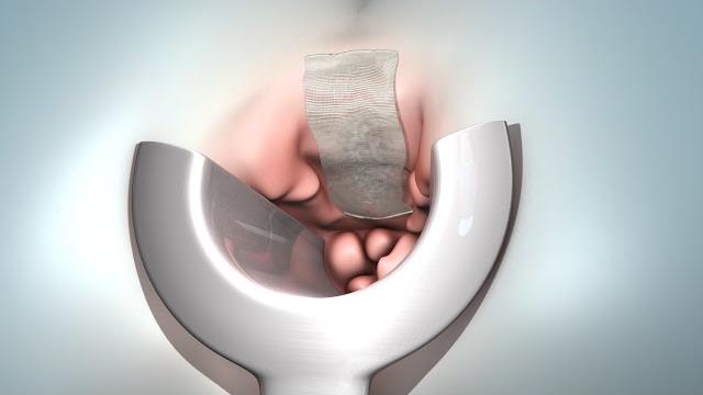 Hemorrhoid removal (hemorrhoidectomy) Hemorrhoid removal (hemorrhoidectomy)