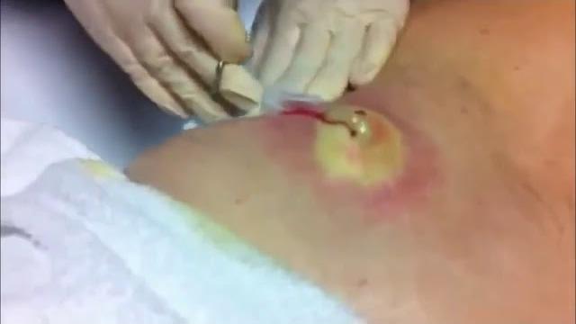 Pimple popping | cyst popping | гигантский прыщ на спине / giant acne on your back - pus extraction Pimple popping | cyst popping | гигантский прыщ на спине / giant acne on your back - pus extraction