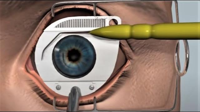 Lasik eye surgery - 3d animation Lasik eye surgery - 3d animation