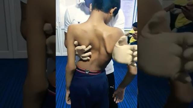 Scoliosis treatment Scoliosis treatment