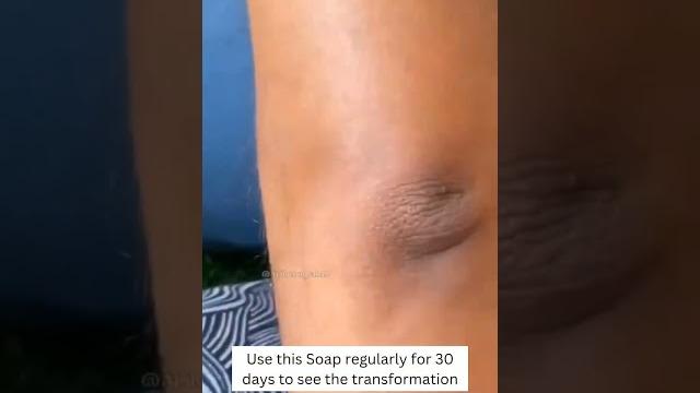 Struggling with dark neck and elbows? Struggling with dark neck and elbows?