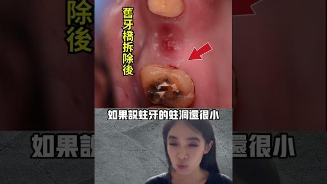 為什麼要拆假牙#牙冠牙橋#抽神經 為什麼要拆假牙#牙冠牙橋#抽神經