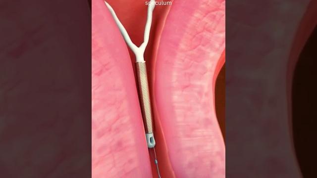 Iud removal #shortvideo #viral Iud removal #shortvideo #viral