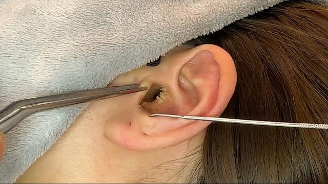 Asmr ear cleaning | this might be the dirtiest ear yet Asmr ear cleaning | this might be the dirtiest ear yet