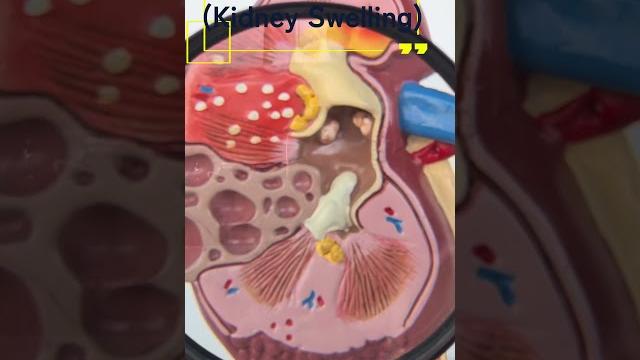 How does frequently holding urine affect your kidneys? - dr. anindya maitra | nephrologist How does frequently holding urine affect your kidneys? - dr. anindya maitra | nephrologist