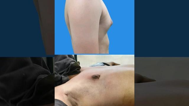 Gynecomastia result ! grade 2a - removed fat and gland | gynecomastia surgery #shorts Gynecomastia result ! grade 2a - removed fat and gland | gynecomastia surgery #shorts
