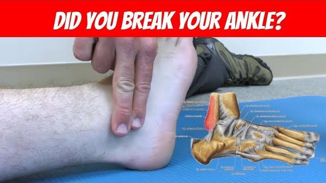 Ankle sprain or fracture? - ottawa ankle rules Ankle sprain or fracture? - ottawa ankle rules