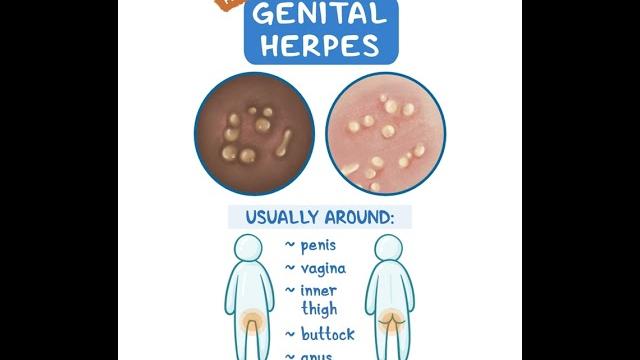 Genital herpes Genital herpes