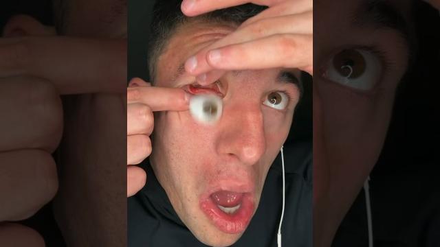 My eyeball popped out My eyeball popped out