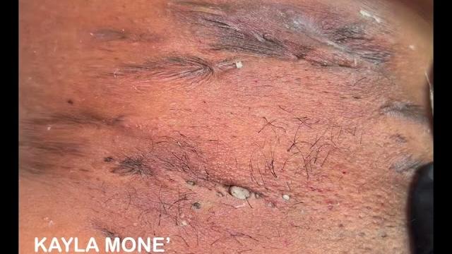 Blackhead and clogged underarm extractions on hs client Blackhead and clogged underarm extractions on hs client