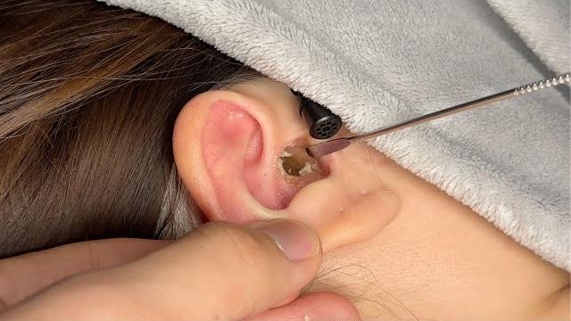 Asmr ear cleaning | relaxing earwax sounds for sleep Asmr ear cleaning | relaxing earwax sounds for sleep