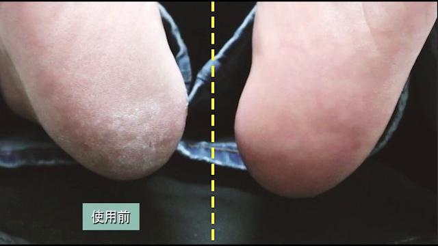 《快速除腳皮》寶貝嫩足去繭蛋豪華5件組 《快速除腳皮》寶貝嫩足去繭蛋豪華5件組