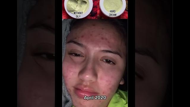 Goree cream | goree whitening cream | pigmentation cream | dark spots remove cream |#shortvideo Goree cream | goree whitening cream | pigmentation cream | dark spots remove cream |#shortvideo