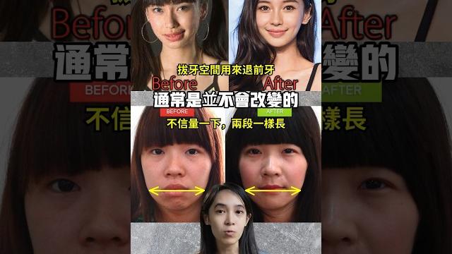 牙齒矯帶對臉型的改變和你想的不一樣#牙齒矯正#戴牙套 牙齒矯帶對臉型的改變和你想的不一樣#牙齒矯正#戴牙套