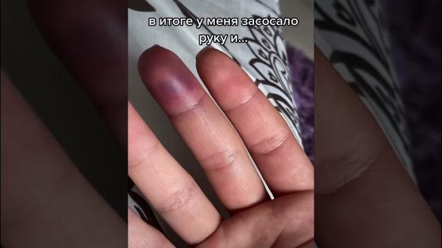 Сломала палец Сломала палец