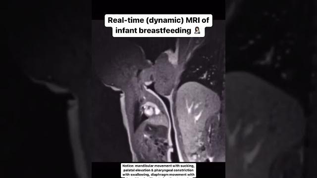 Real-time (dynamic) mri of infant breastfeeding Real-time (dynamic) mri of infant breastfeeding