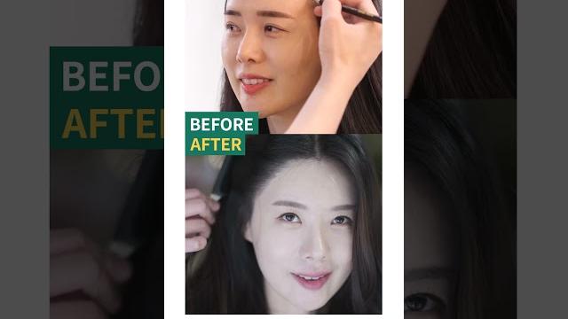 Bj바카스님의 절개모발이식 1년 경과 before&after Bj바카스님의 절개모발이식 1년 경과 before&after