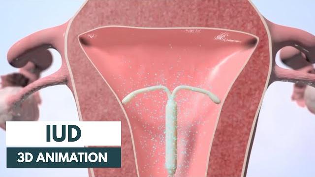 How does an iud work? | 3d animation How does an iud work? | 3d animation
