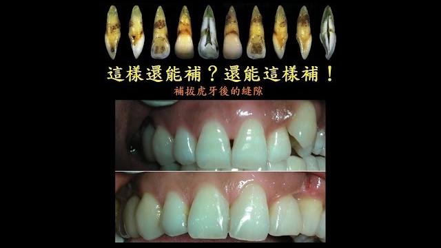 這樣還能補?還能這樣補!__補拔虎牙後的縫隙(1080p) 這樣還能補?還能這樣補!__補拔虎牙後的縫隙(1080p)