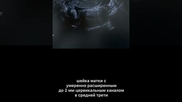 Узи шейки матки в середине менструального цикла Узи шейки матки в середине менструального цикла