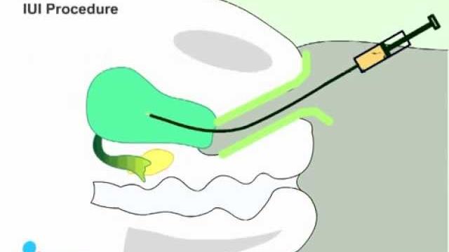 Iui procedure Iui procedure