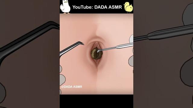 Asmr | remove huge navel stone animation Asmr | remove huge navel stone animation