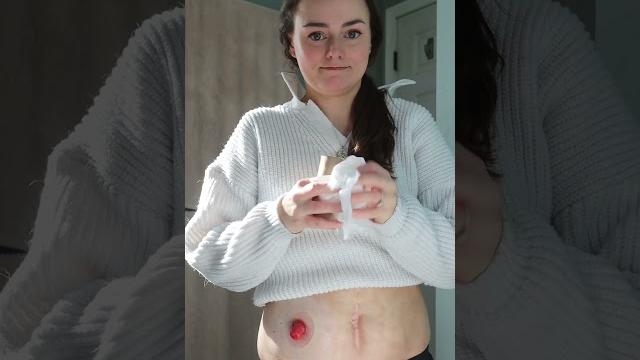When your stoma is active but you need to change that ostomy now! | #shorts | let's talk ibd When your stoma is active but you need to change that ostomy now! | #shorts | let's talk ibd