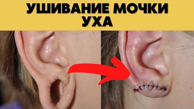 Ушивание мочки уха Ушивание мочки уха