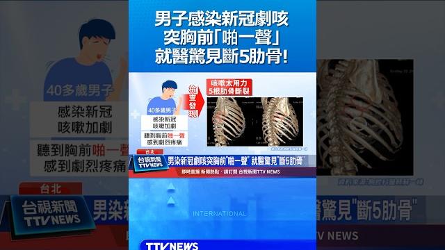 男染新冠劇咳突胸前「啪一聲」就醫驚見斷5肋骨!#新冠 #疫情 #肋骨 #咳嗽 男染新冠劇咳突胸前「啪一聲」就醫驚見斷5肋骨!#新冠 #疫情 #肋骨 #咳嗽