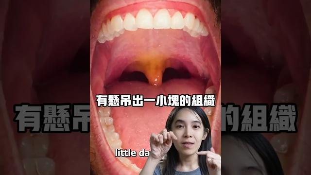 喉嚨深處懸吊的這一小團肉有什麼作用 喉嚨深處懸吊的這一小團肉有什麼作用