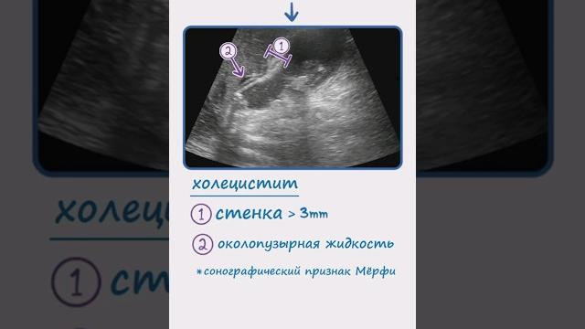 Острый холецистит (узи диагностика) Острый холецистит (узи диагностика)
