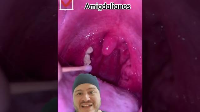 Bolinhas na garganta - como remover cáseos amigdalianos Bolinhas na garganta - como remover cáseos amigdalianos