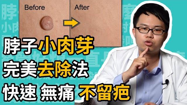 脖子長小肉芽、贅疣、瘜肉、肉疣、皮贅,如何治療,快速、有效又不留疤?皮膚科楊省三醫師教你這樣做! 脖子長小肉芽、贅疣、瘜肉、肉疣、皮贅,如何治療,快速、有效又不留疤?皮膚科楊省三醫師教你這樣做!