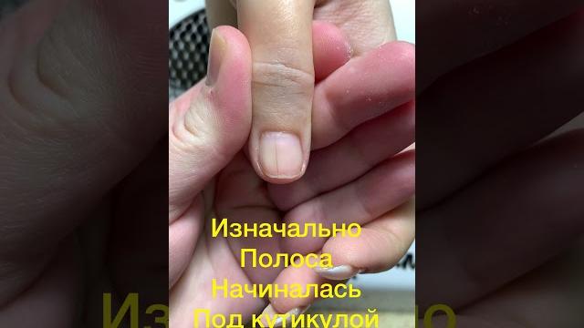Меланома/дистрофия Меланома/дистрофия