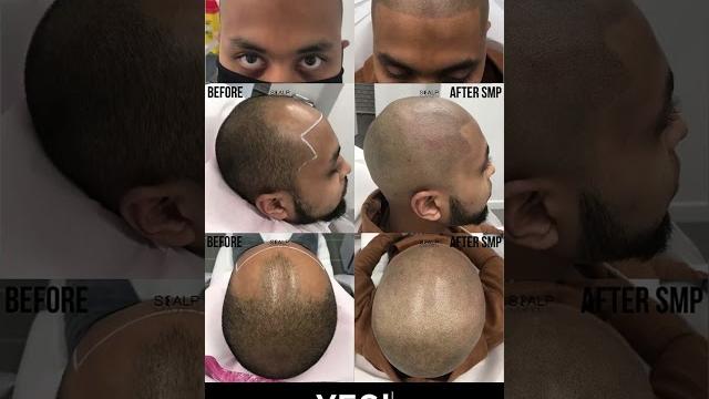 Boxed hairline perfection #scalpmicropigmentation #smp #hairlinetattoo #balding #highfade #shorts Boxed hairline perfection #scalpmicropigmentation #smp #hairlinetattoo #balding #highfade #shorts