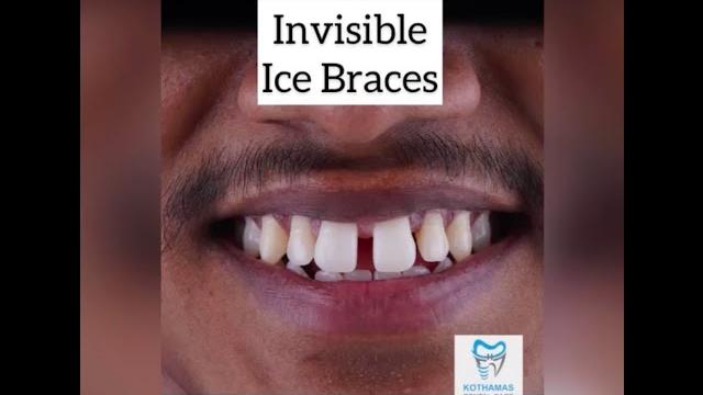 How braces are put on - crystal clear braces #shorts How braces are put on - crystal clear braces #shorts