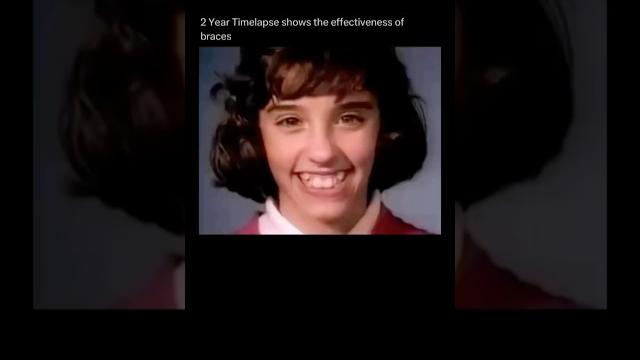 2 year timelapse shows the effectiveness of braces 2 year timelapse shows the effectiveness of braces