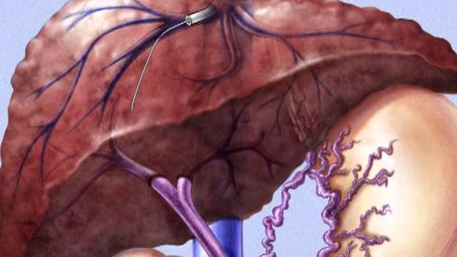 Tipss, transjugular intrahepatic porto-systemic shunt Tipss, transjugular intrahepatic porto-systemic shunt