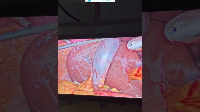 Durbin se surgery kaise hoti hai ? laparoscopic operation ka tarika kya hai ? laparoscopic surgery Durbin se surgery kaise hoti hai ? laparoscopic operation ka tarika kya hai ? laparoscopic surgery