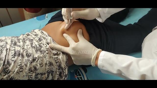 Intramuscular injection into the gluteal muscle #doctor #intramuscularinjection #injection Intramuscular injection into the gluteal muscle #doctor #intramuscularinjection #injection