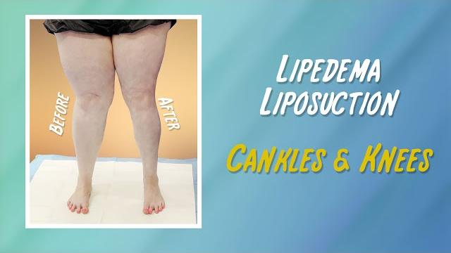 Lipedema | leg liposuction surgery results | lipo 360° legs | cankles & knees | expert dr. thomas su Lipedema | leg liposuction surgery results | lipo 360° legs | cankles & knees | expert dr. thomas su