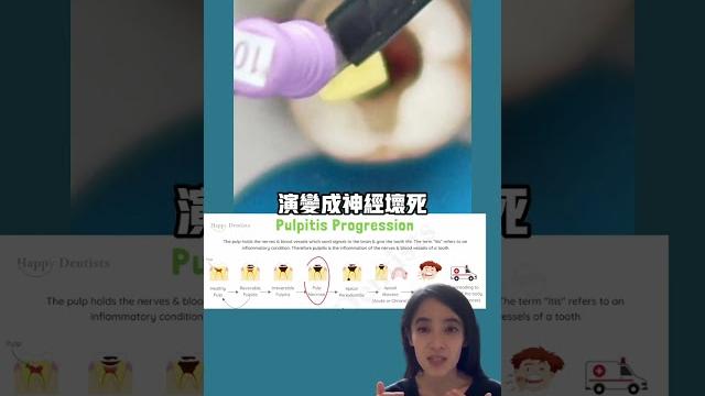 根管治療成功機率#牙髓炎#牙髓壞死#牙包 根管治療成功機率#牙髓炎#牙髓壞死#牙包