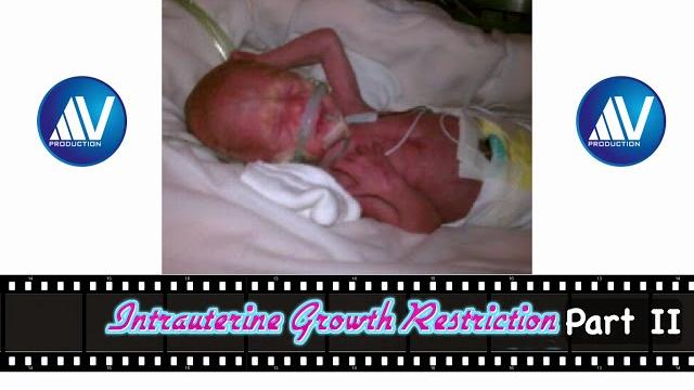 Intrauterine growth restriction part ii Intrauterine growth restriction part ii