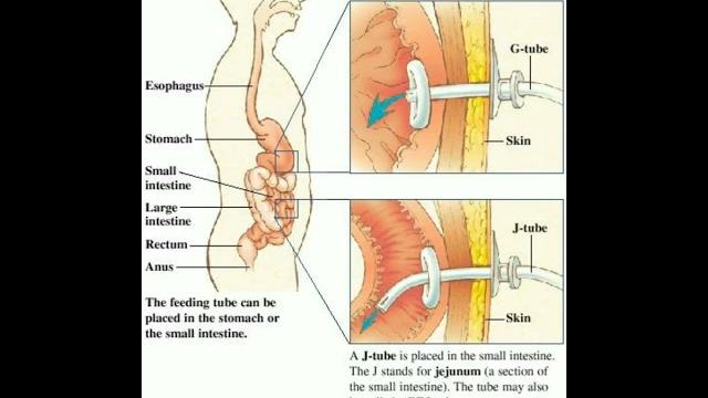 G tube j tube #doctor #shortsfeed #short G tube j tube #doctor #shortsfeed #short