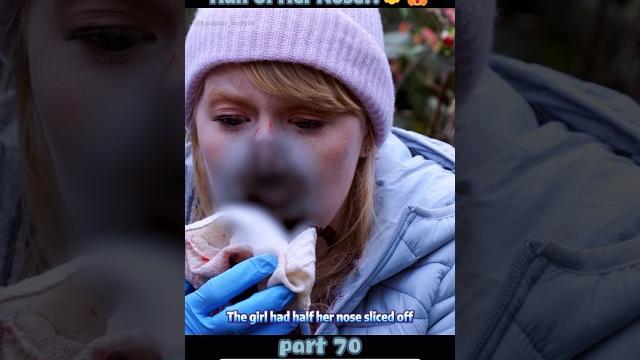 Drone slices off half of her nose?!【part 70】 Drone slices off half of her nose?!【part 70】