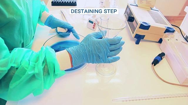 Serum protein electrophoresis Serum protein electrophoresis