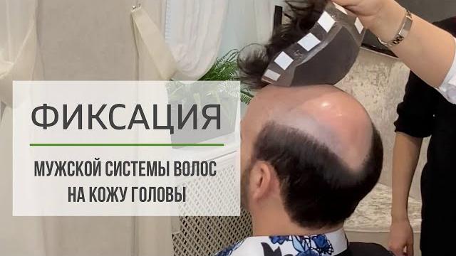 Фиксируем мужскую систему волос на кожу головы Фиксируем мужскую систему волос на кожу головы