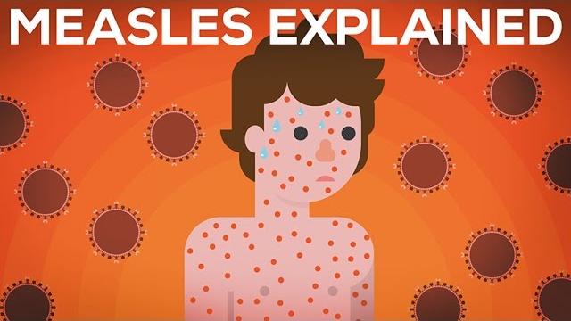Measles explained — vaccinate or not? Measles explained — vaccinate or not?