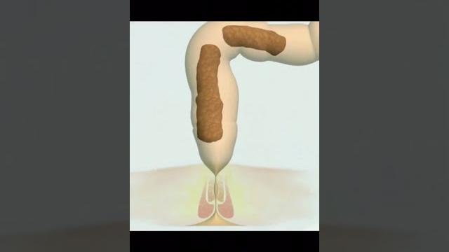 Proses bab di usus Proses bab di usus