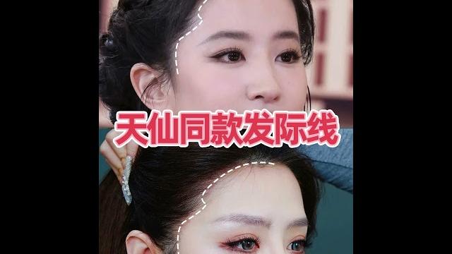 Recreating liu yifei’s natural “born-with-it” hairline | real case from lotus hair transplant Recreating liu yifei’s natural “born-with-it” hairline | real case from lotus hair transplant